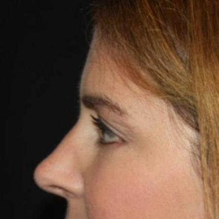 After image 3 Case #85171 - Blepharoplasty and Browlift - 45 year old female