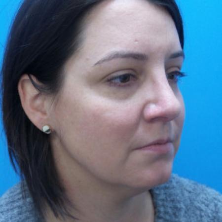 After image 2 Case #88206 - 40 year old  -  Rhinoplasty & Septoplasty  -  1 month post-op