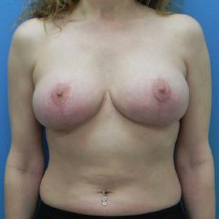 After image 1 Case #80981 - Mastopexy  (Breast Lift)