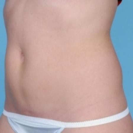 After image 2 Case #79281 - Non-Surgical