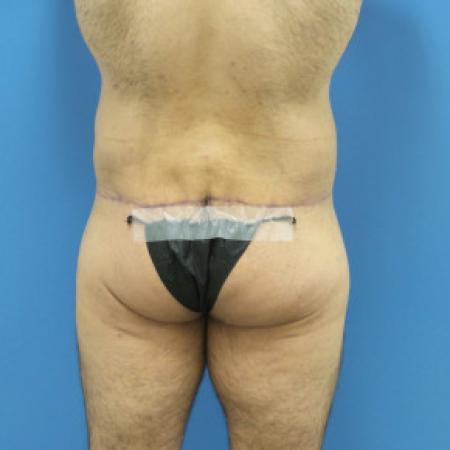 After Case #88451 - Circumferential Body Lift /Gynecomastia Reduction