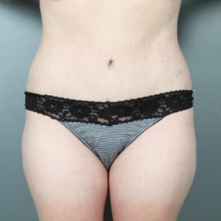After image 1 Case #83366 - Abdominoplasty