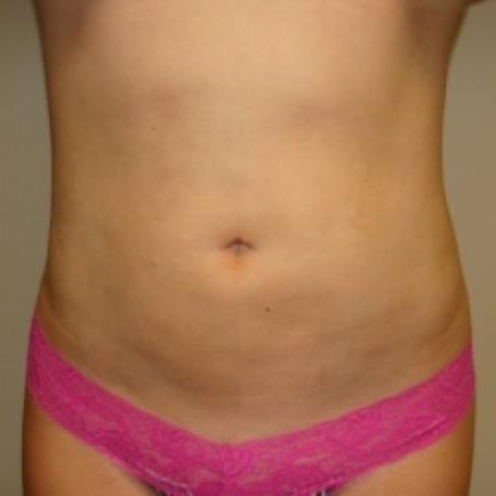 After image 1 Case #79946 - Liposuction