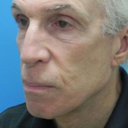 After image 2 Case #86696 - Facelift - 2 months post-op