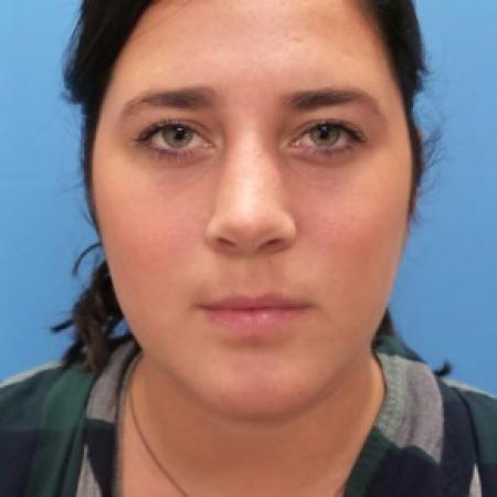 After image 1 Case #86451 - Rhinoplasty/Septoplasty/Turbinectomy