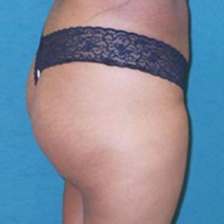 After image 1 Case #84911 - Buttock Augmenation with implants and liposuction of the abdomen