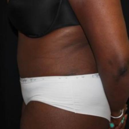 After image 3 Case #84586 - Abdominoplasty - 51 year old female
