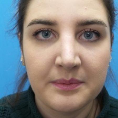 After image 1 Case #86551 - Rhinoplasty  3 months post-op