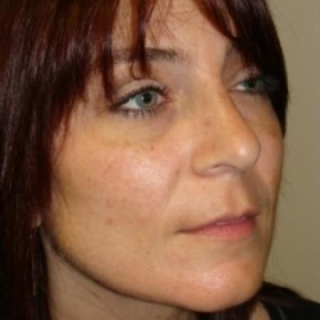 After image 3 Case #79556 - Rhinoplasty
