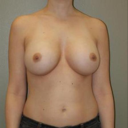 After image 1 Case #80861 - Breast Augmentation