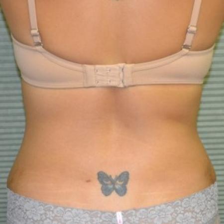 After image 3 Case #87836 - Tummy Tuck and liposuction of flanks
