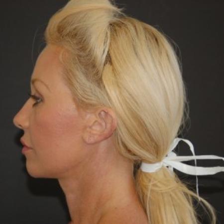 After image 2 Case #82826 - Face Lift, Neck Lift, and Endoscopic Forehead Lift 
