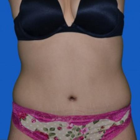 After image 1 Case #87851 - Tummy Tuck