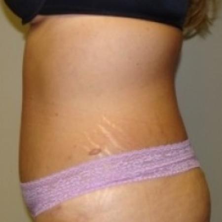 After image 3 Case #79471 - Tummy Tuck