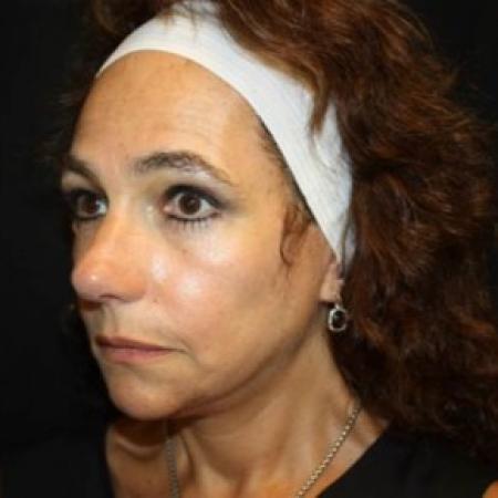 After image 2 Case #85061 - Facelift and Neck Lift - 58 year old female