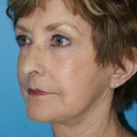 After image 2 Case #86621 - Facelift/Liposuction of the Neck/Laser Resurfacing to Full Face     3 months post-op