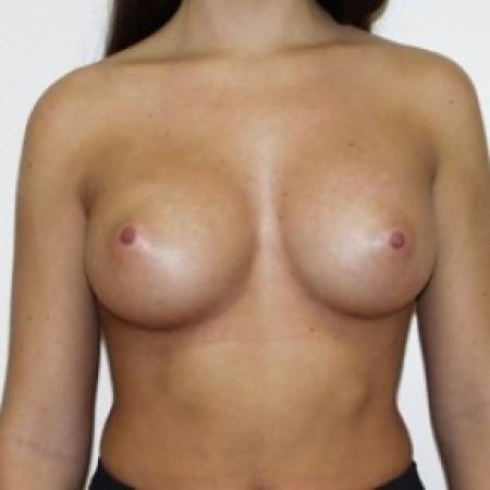 After image 1 Case #81001 - Breast Augmentation