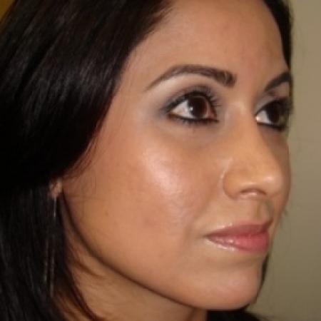 After image 4 Case #79041 - Rhinoplasty
