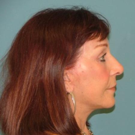After image 3 Case #86726 - Facelift+eyelid surgery+forehead lift