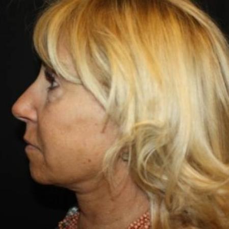 After image 3 Case #85796 - Face-lift, Brow-lift, Necklift - 68 year old female