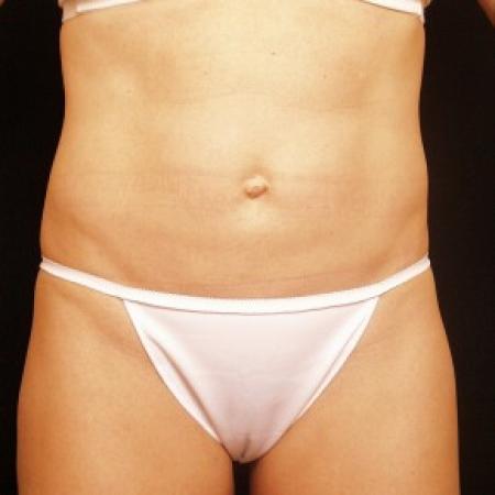 After image 1 Case #81751 - Liposuction