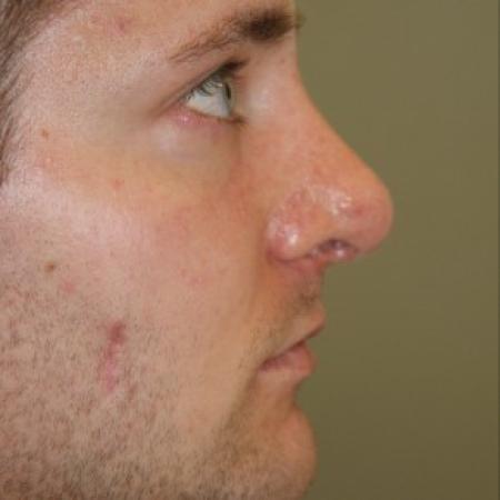 After image 2 Case #81896 - Open Structure Septorhinoplasty and Sub-Mucous Resection