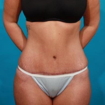 After image 1 Case #84071 - Abdominoplasty with Flank Lipo
