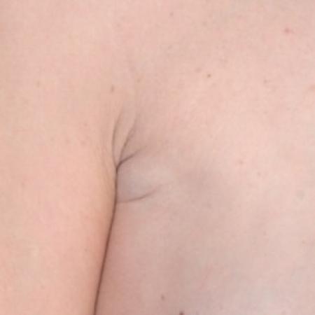After image 2 Case #82226 - Excised Lipoma