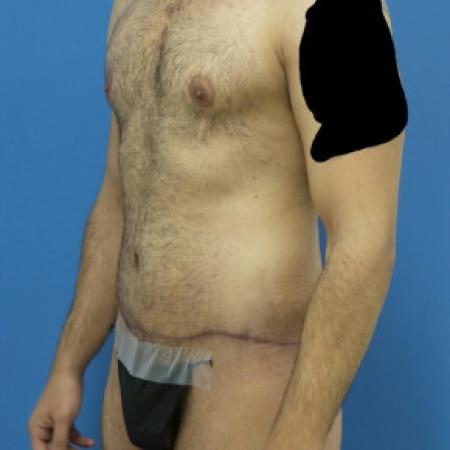 After Case #88451 - Circumferential Body Lift /Gynecomastia Reduction