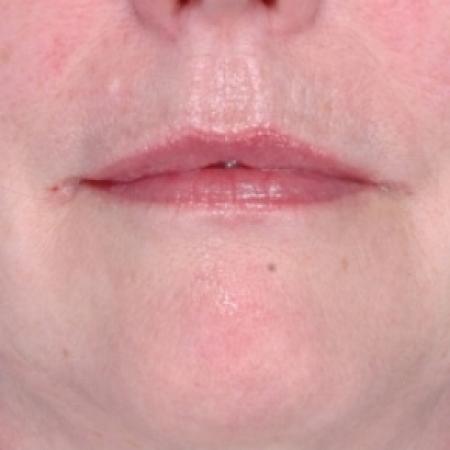 After image 1 Case #79286 - Injectables