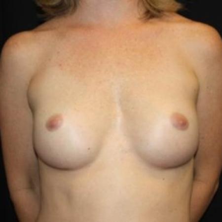 After image 1 Case #84881 - Breast Augmentation - 40 year old female