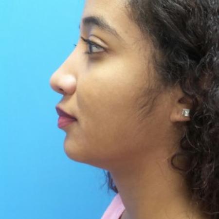 After image 3 Case #86471 - Rhinoplasty/Septoplasty/Turbinectomy - 1 year post-op