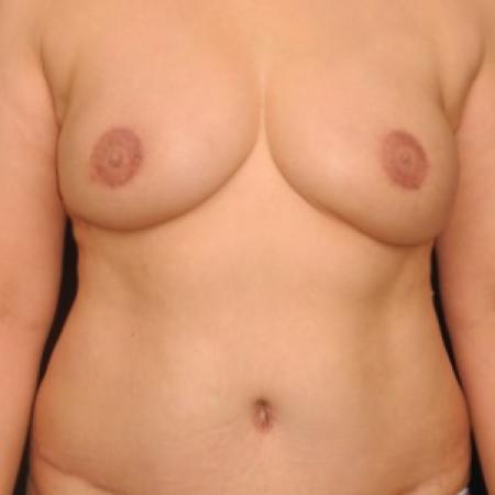 After image 1 Case #82961 - 52 y/o - Immediate DIEP Flap Breast Reconstruction