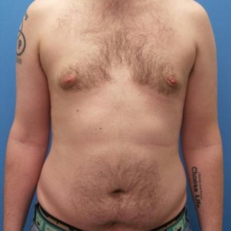 After image 1 Case #86406 - Gynecomastia