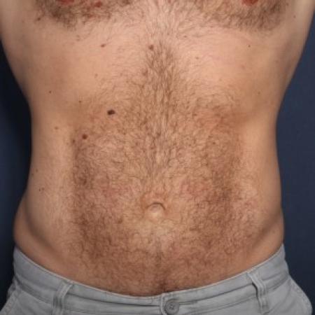 After image 1 Case #84591 - 39 Year Old Male 
