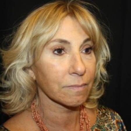 After image 2 Case #85796 - Face-lift, Brow-lift, Necklift - 68 year old female