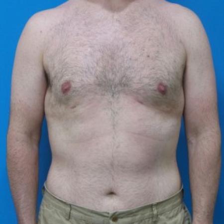 After image 1 Case #87421 - 45 year-old  -  Liposuction to Chest with Renuvion (SkinTite) /Liposuction to Lateral Flanks - 4 months post-op