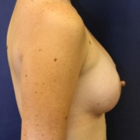 After image 2 Case #81216 - Breast Augmentation