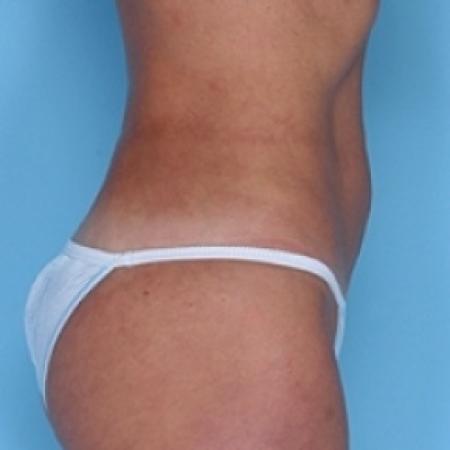 After image 2 Case #79241 - Liposuction