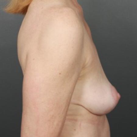 After image 2 Case #83706 - Implant Removal