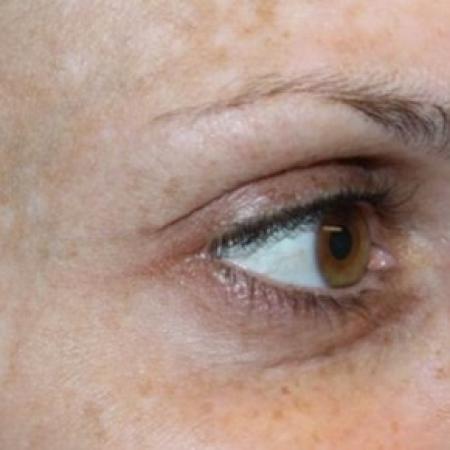 After image 3 Case #83891 - Botox (Crows Feet Only) - 34 year old female.