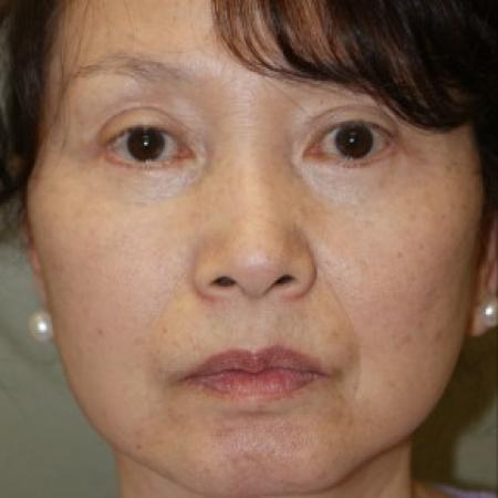 After image 1 Case #81911 - Facelift
