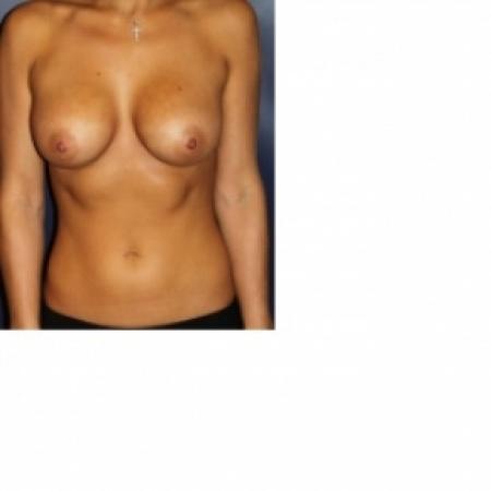 After image 1 Case #80806 - Natural Proportional Breast Augmentation