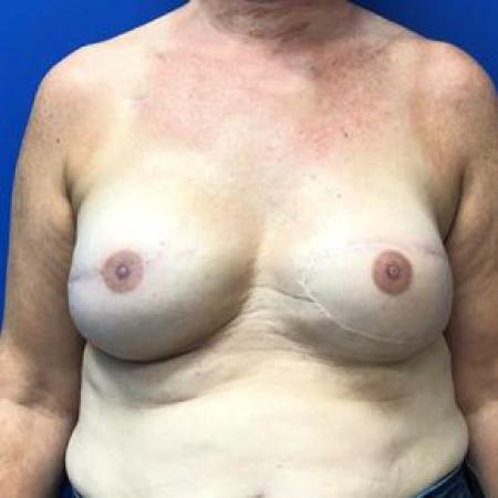 After image 1 Case #88201 - Breast Reconstruction on a 49 year old female