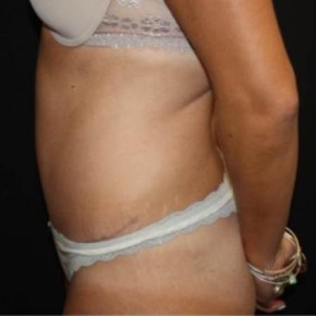 After image 3 Case #84291 - Abdominoplasty - 39 year old female