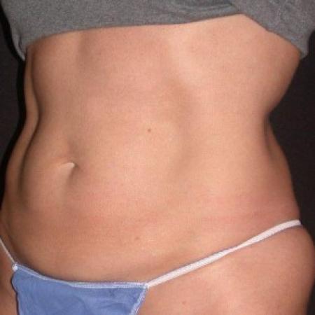 After image 1 Case #81866 - CoolSculpting