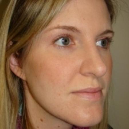 After image 3 Case #79551 - Rhinoplasty