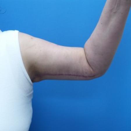 After image 1 Case #86956 - 51 year old   -    Brachioplasty (Arm Lift)   -  5 months post-op