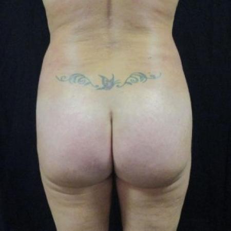 After Case #82641 - Fat transfer to Buttocks
