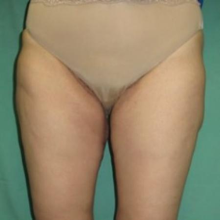 After Case #85671 - Thigh Lift 